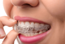 The Smart Way To Align Your Teeth Without Braces