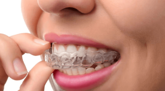 The Smart Way To Align Your Teeth Without Braces